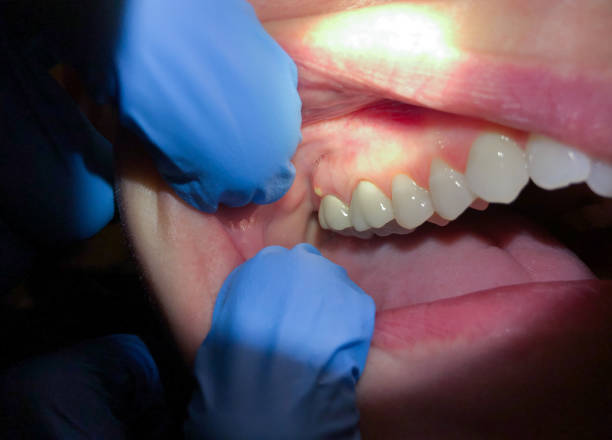 Best Emergency Dental Care for Broken or Chipped Teeth in Mayflower Village, CA